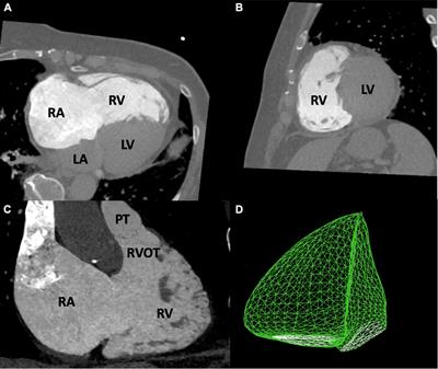 Right ventricular function in transcatheter mitral and tricuspid valve edge-to-edge repair
